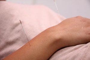 Acupuntura China Medicina Oriental en Las Condes