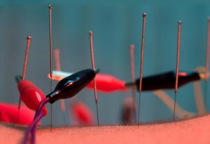 Acupuntura China Medicina Oriental en Las Condes