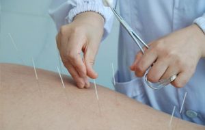 Acupuntura China Medicina Oriental en Las Condes