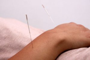 Acupuntura China Medicina Oriental en Las Condes